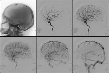 Smegenų kraujagyslių angiografija: kas tai yra, indikacijos ir kontraindikacijos