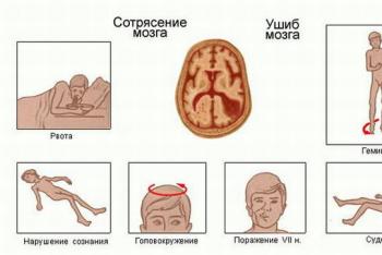 Signs and symptoms of mild to severe concussion